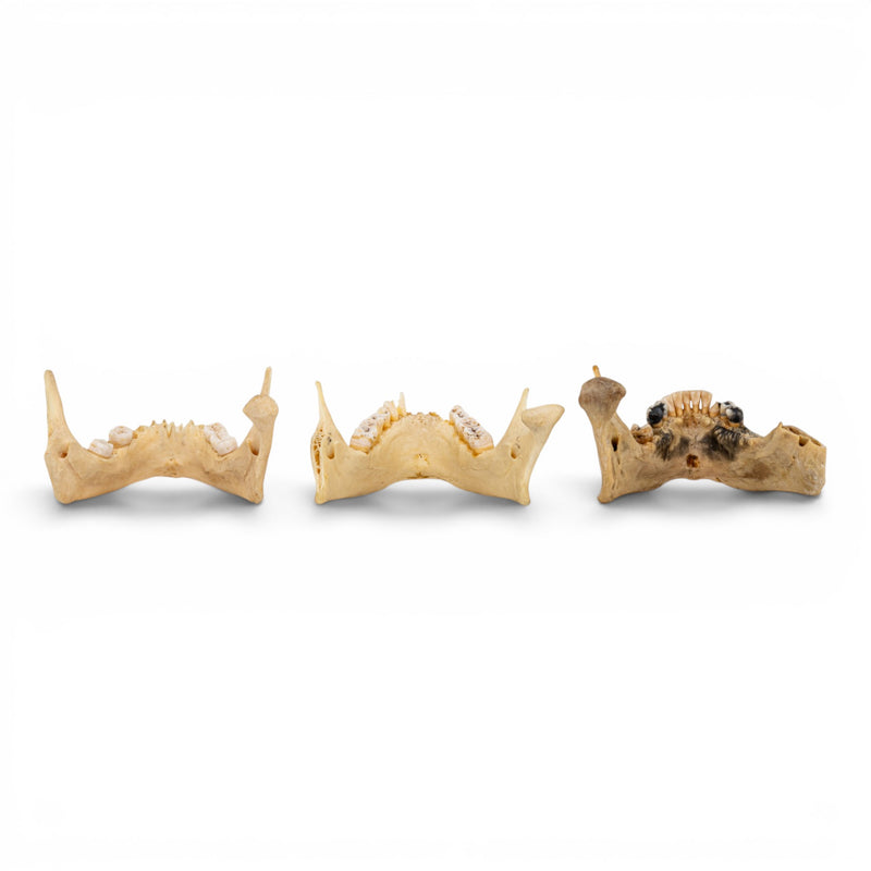 Real Human Mandible - Pathology - Set of 3