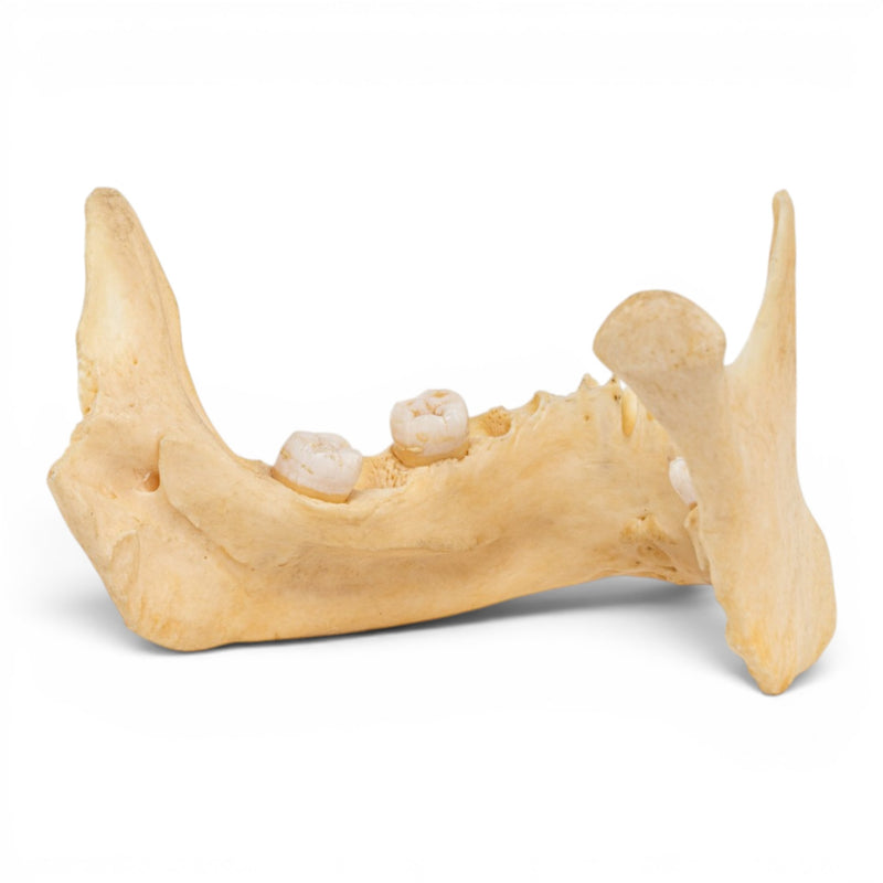 Real Human Mandible - Pathology - Set of 3