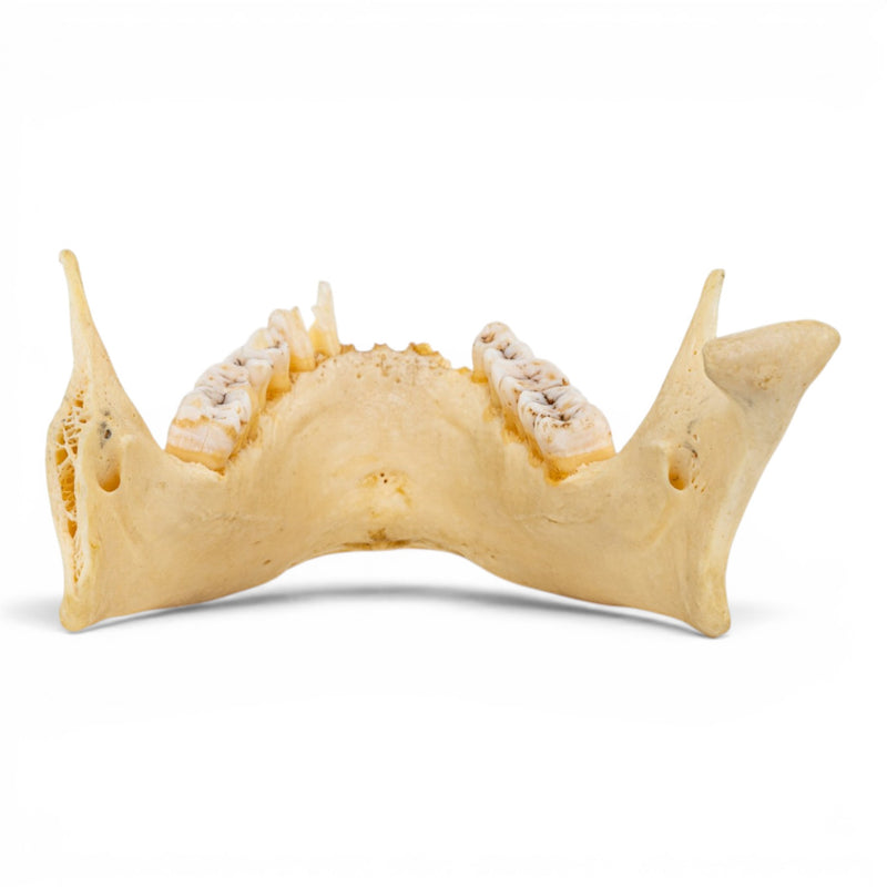 Real Human Mandible - Pathology - Set of 3