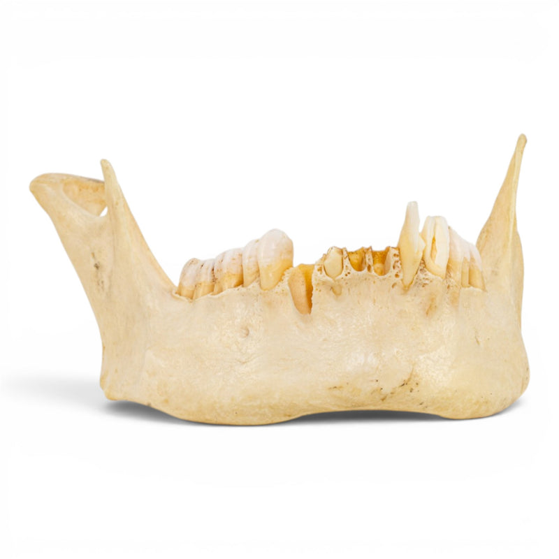 Real Human Mandible - Pathology - Set of 3
