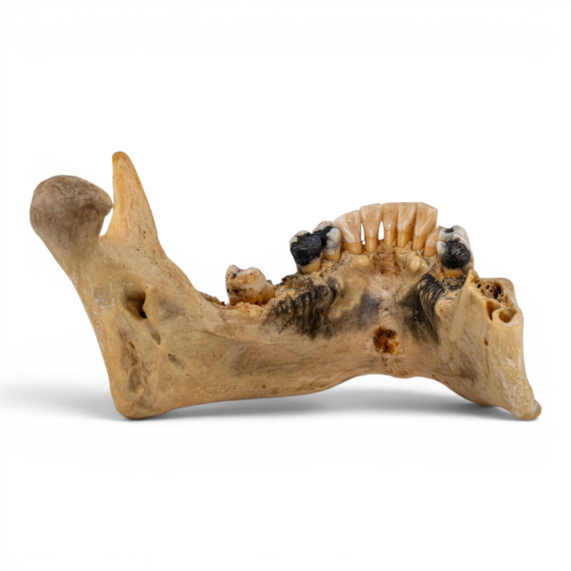 Real Human Mandible - Pathology - Set of 3