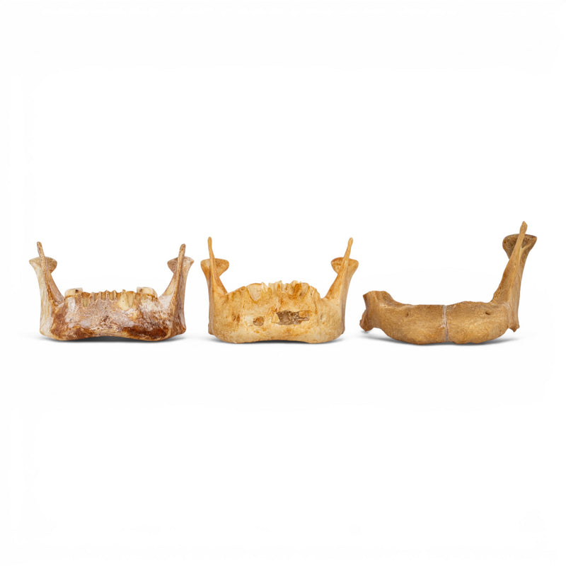 Real Human Mandible - Pathology - Set of 3