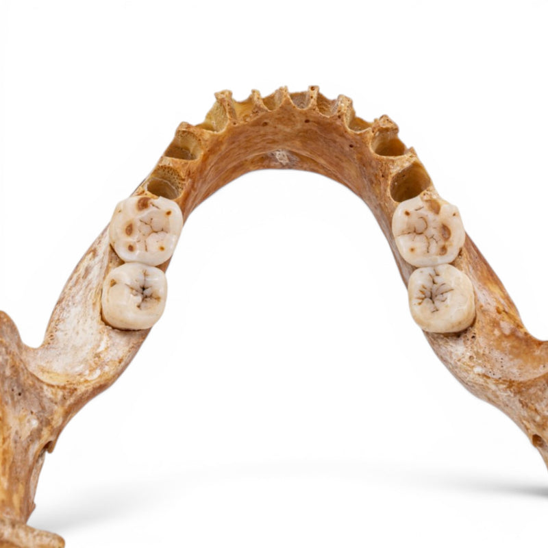 Real Human Mandible - Pathology - Set of 3