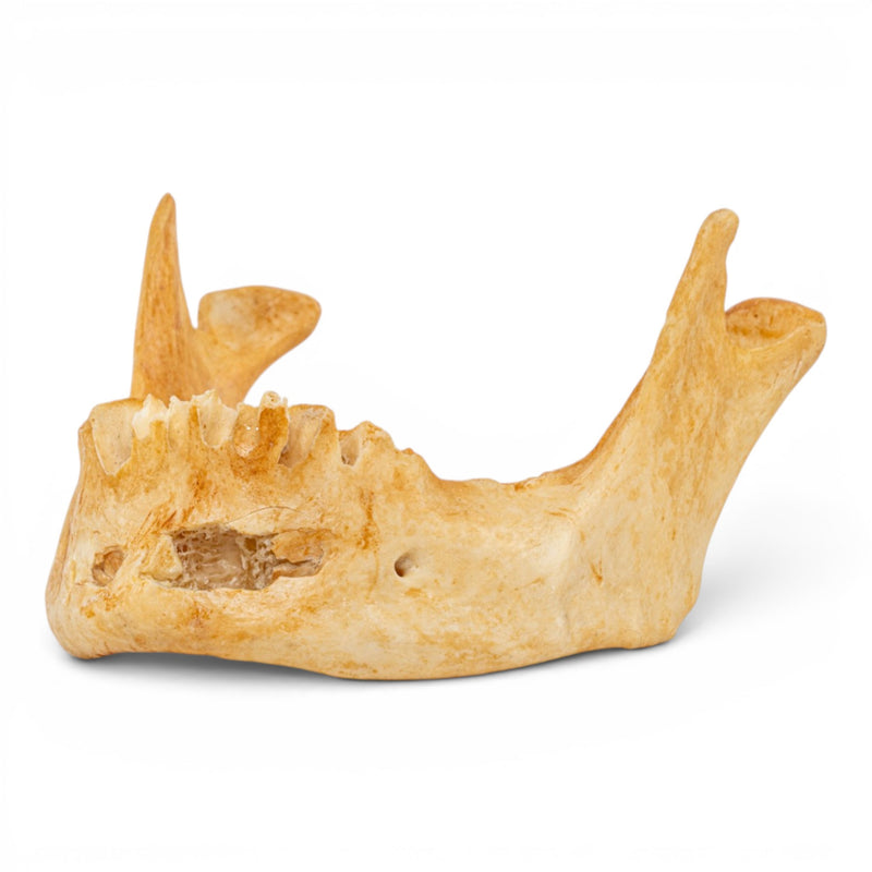 Real Human Mandible - Pathology - Set of 3