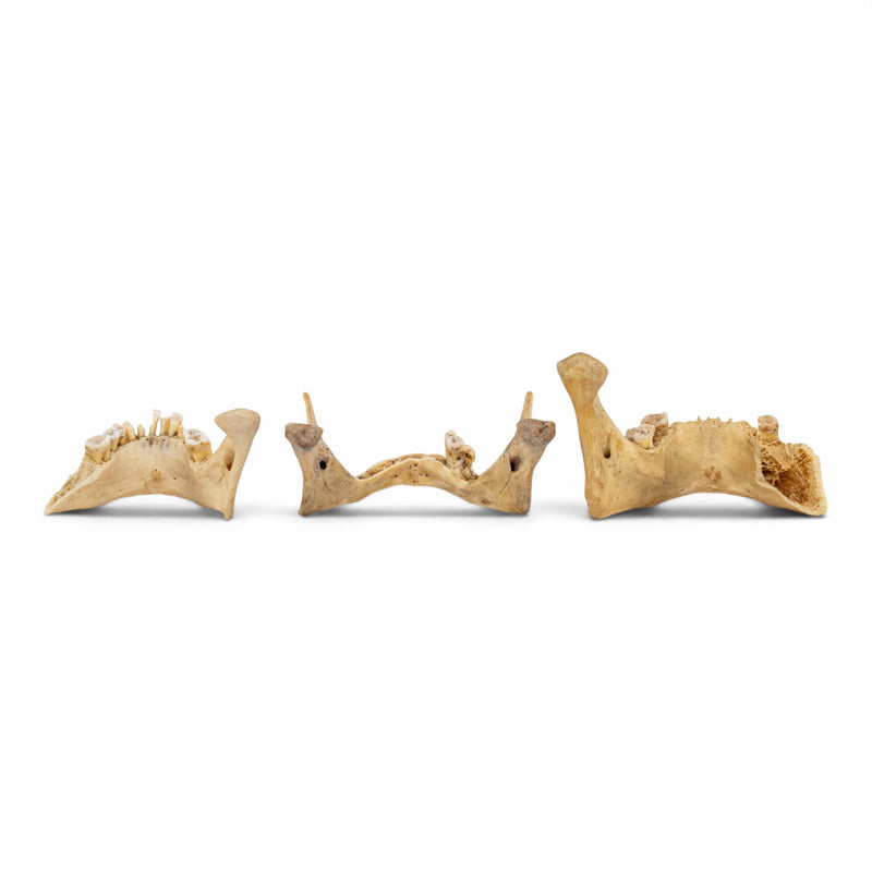 Real Human Mandible - Pathology - Set Of 3