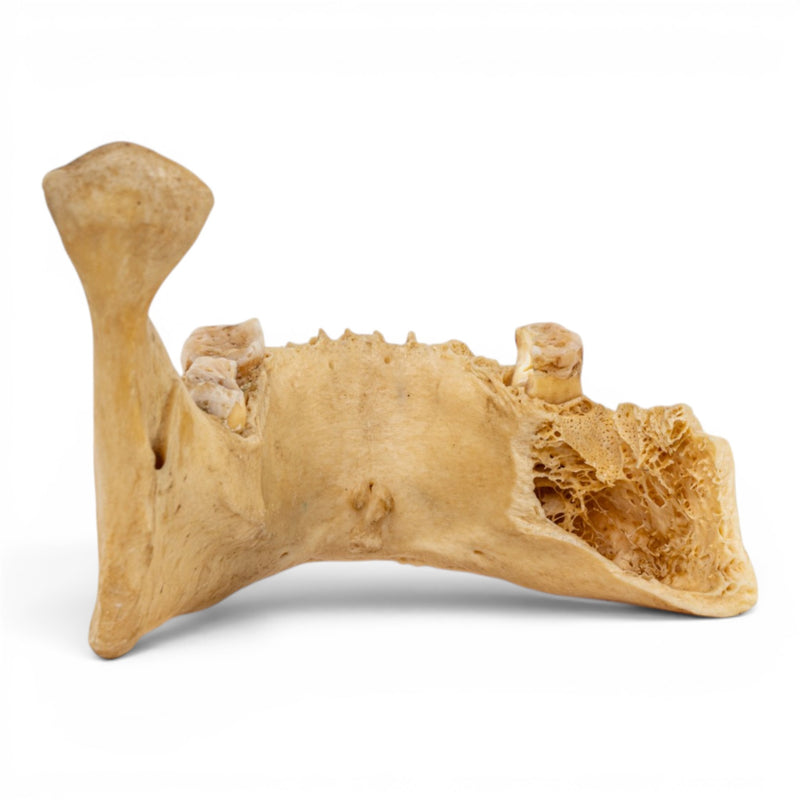 Real Human Mandible - Pathology - Set Of 3