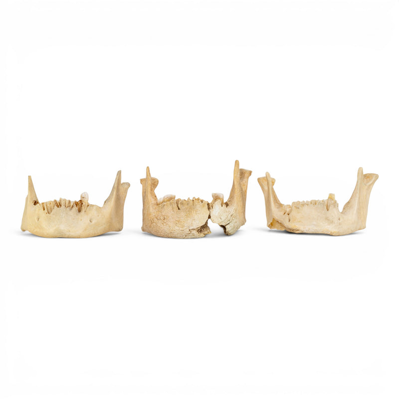 Real Human Mandible - Pathology - Set Of 3