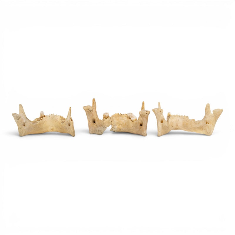 Real Human Mandible - Pathology - Set Of 3