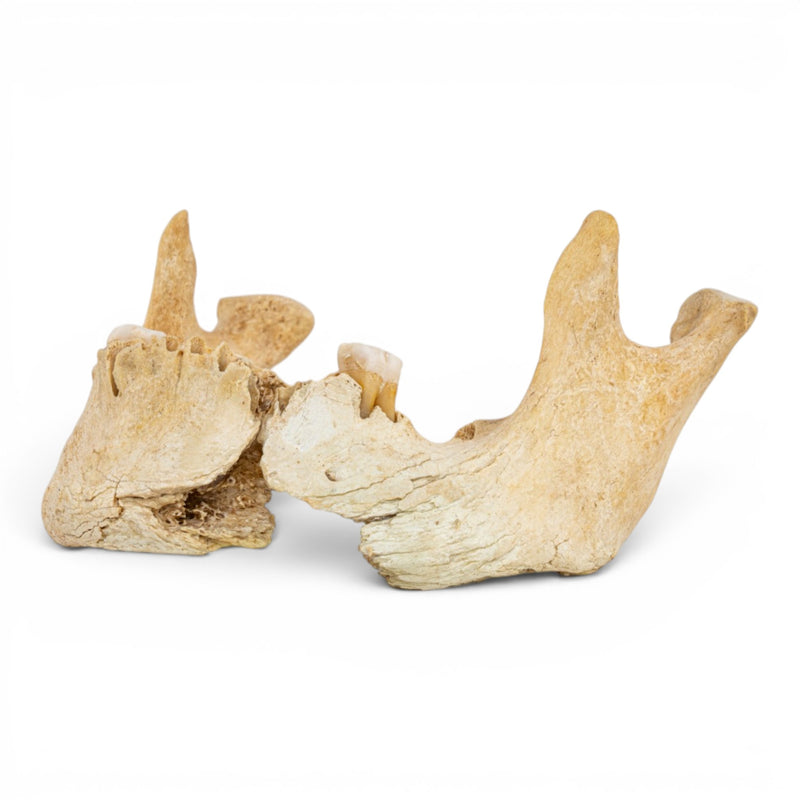 Real Human Mandible - Pathology - Set Of 3