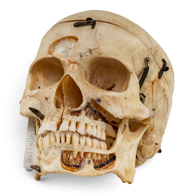 Real Human Skull - Dissected - with Carrying Case