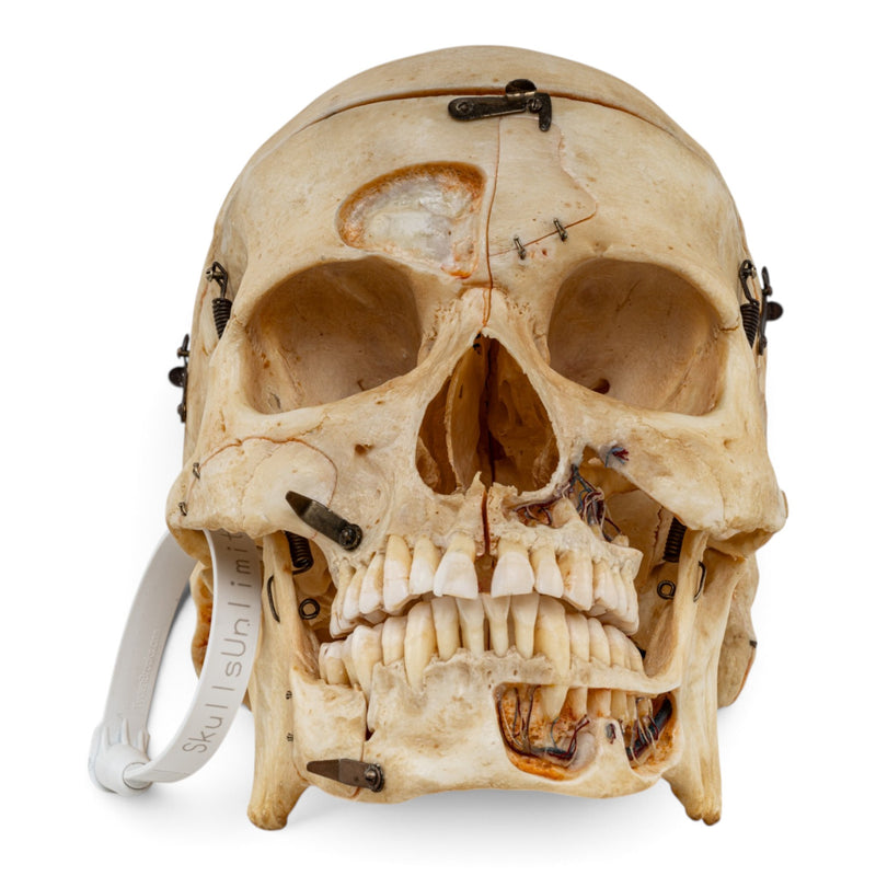 Real Human Skull - Dissected - with Carrying Case