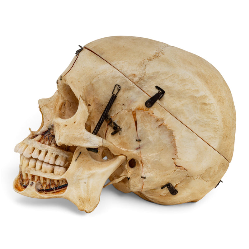 Real Human Skull - Dissected - with Carrying Case