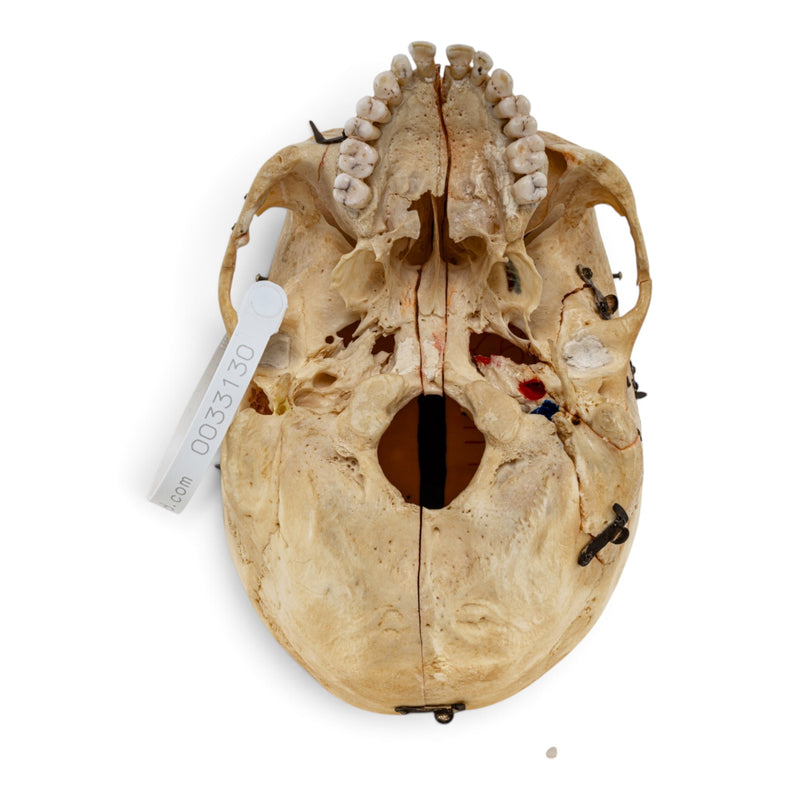 Real Human Skull - Dissected - with Carrying Case