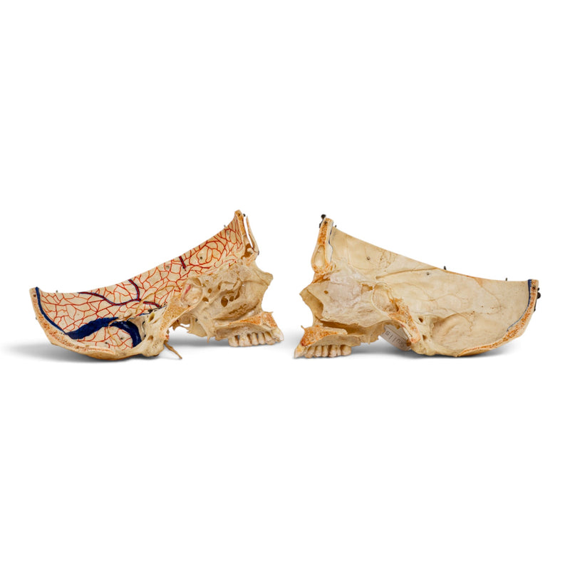 Real Human Skull - Dissected - with Carrying Case