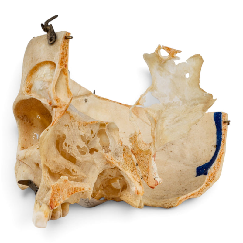 Real Human Skull - Dissected - with Carrying Case