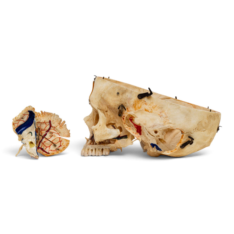 Real Human Skull - Dissected - with Carrying Case