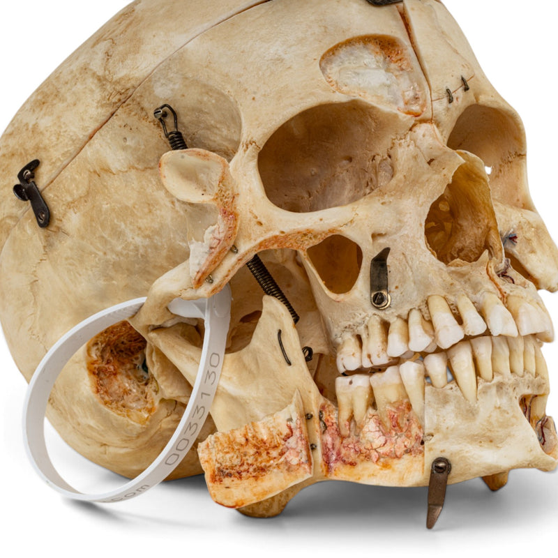 Real Human Skull - Dissected - with Carrying Case