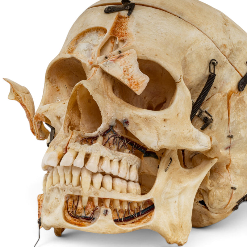 Real Human Skull - Dissected - with Carrying Case