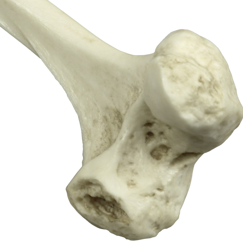 Replica Human Left Femur with Polio