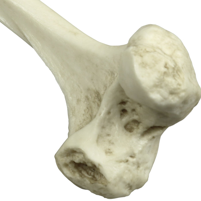 Replica Human Left Femur with Polio