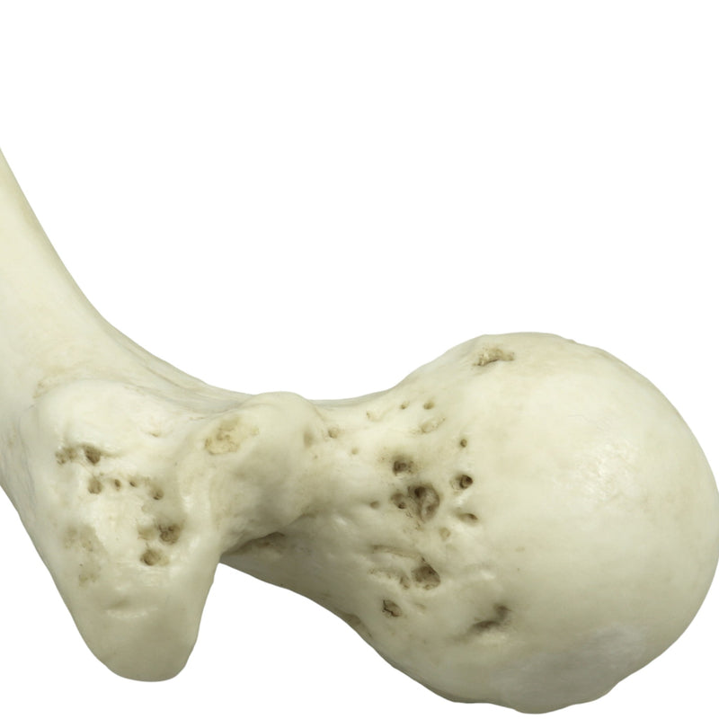 Replica Human Left Femur with Polio