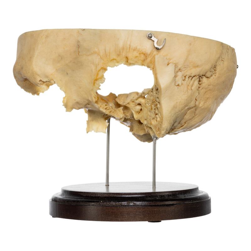 Real Human Partial Skull on Stand