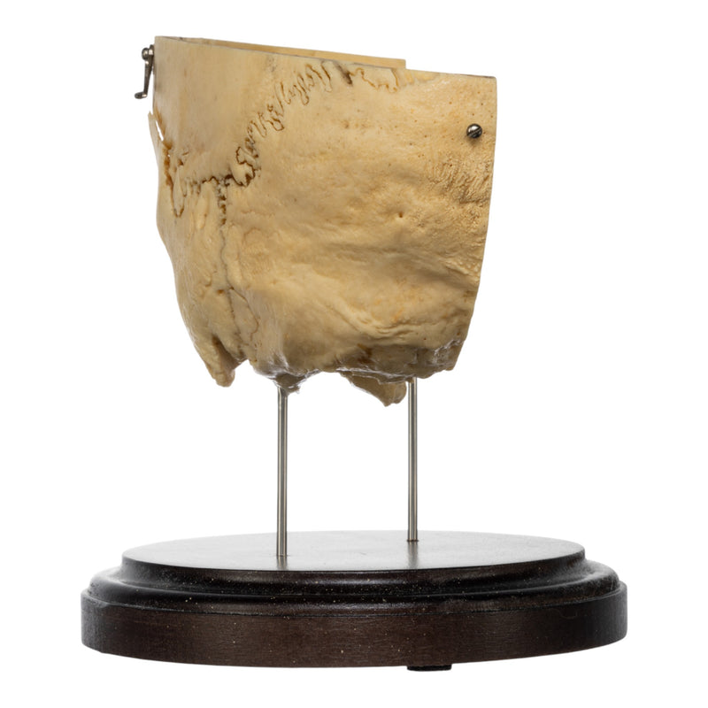 Real Human Partial Skull on Stand