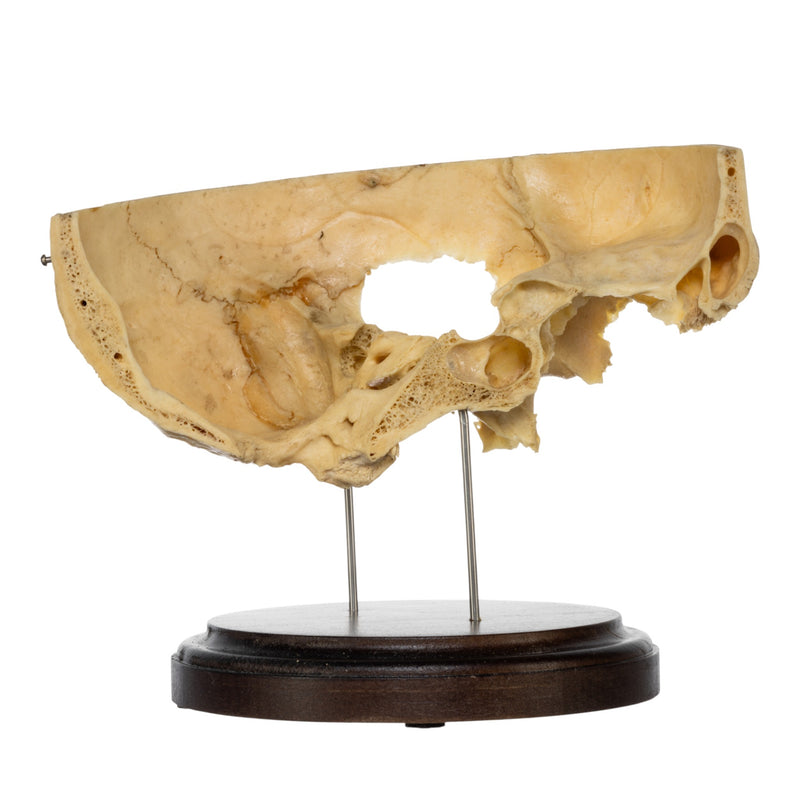 Real Human Partial Skull on Stand