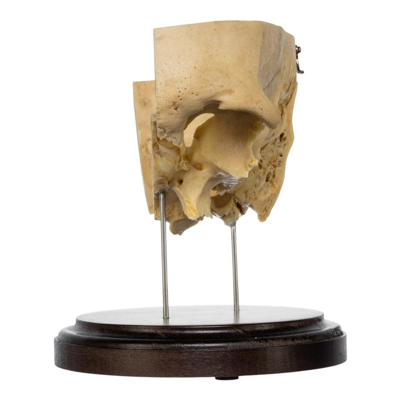 Real Human Partial Skull on Stand