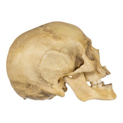 Replica Human Male with a 32-caliber Gunshot Wound Skull