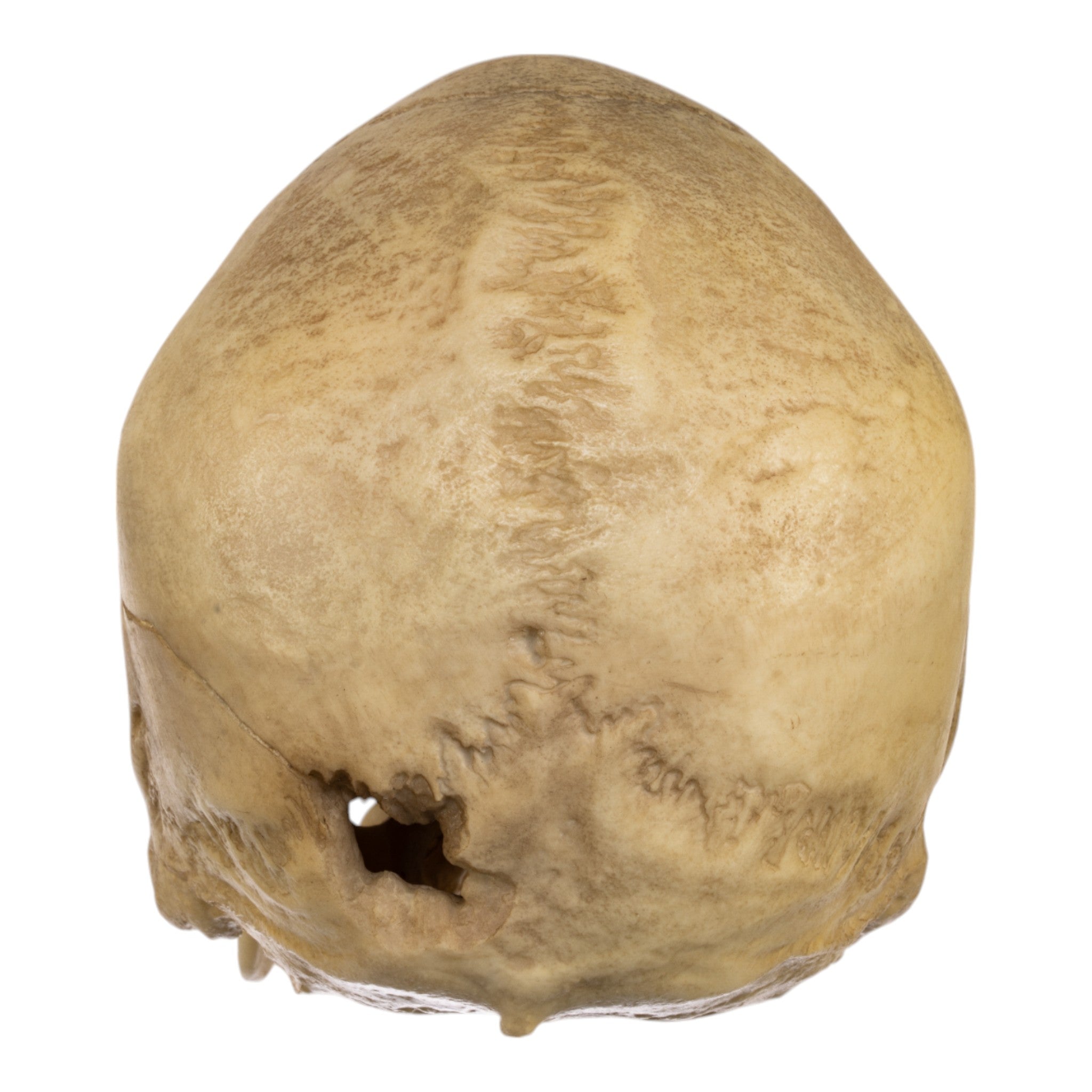 Replica Human Male with a 32-caliber Gunshot Wound Skull For Sale