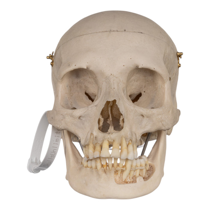 Real Human Skull - Exposed Dentition