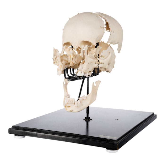 Real Human Exploded Skull on Stand