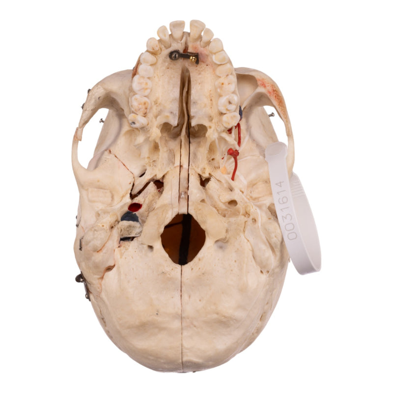 Real Human Dissected Skull with Carrying Case