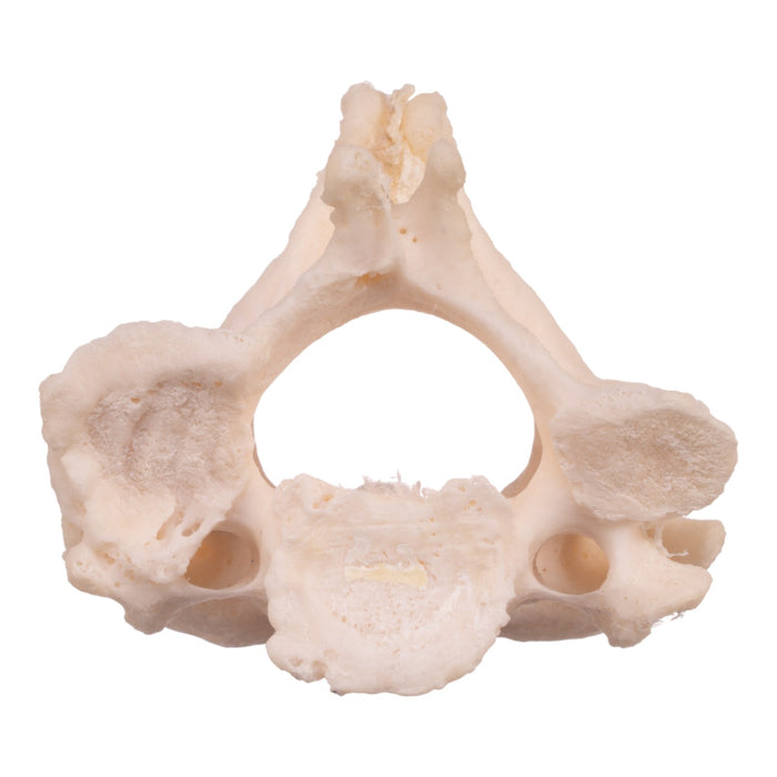 Real Research Quality Human Cervical and Axis Vertebrae - Fused