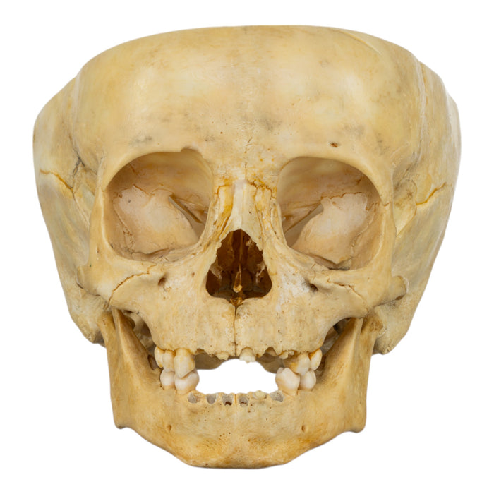 Real Human Child Skull - Partial