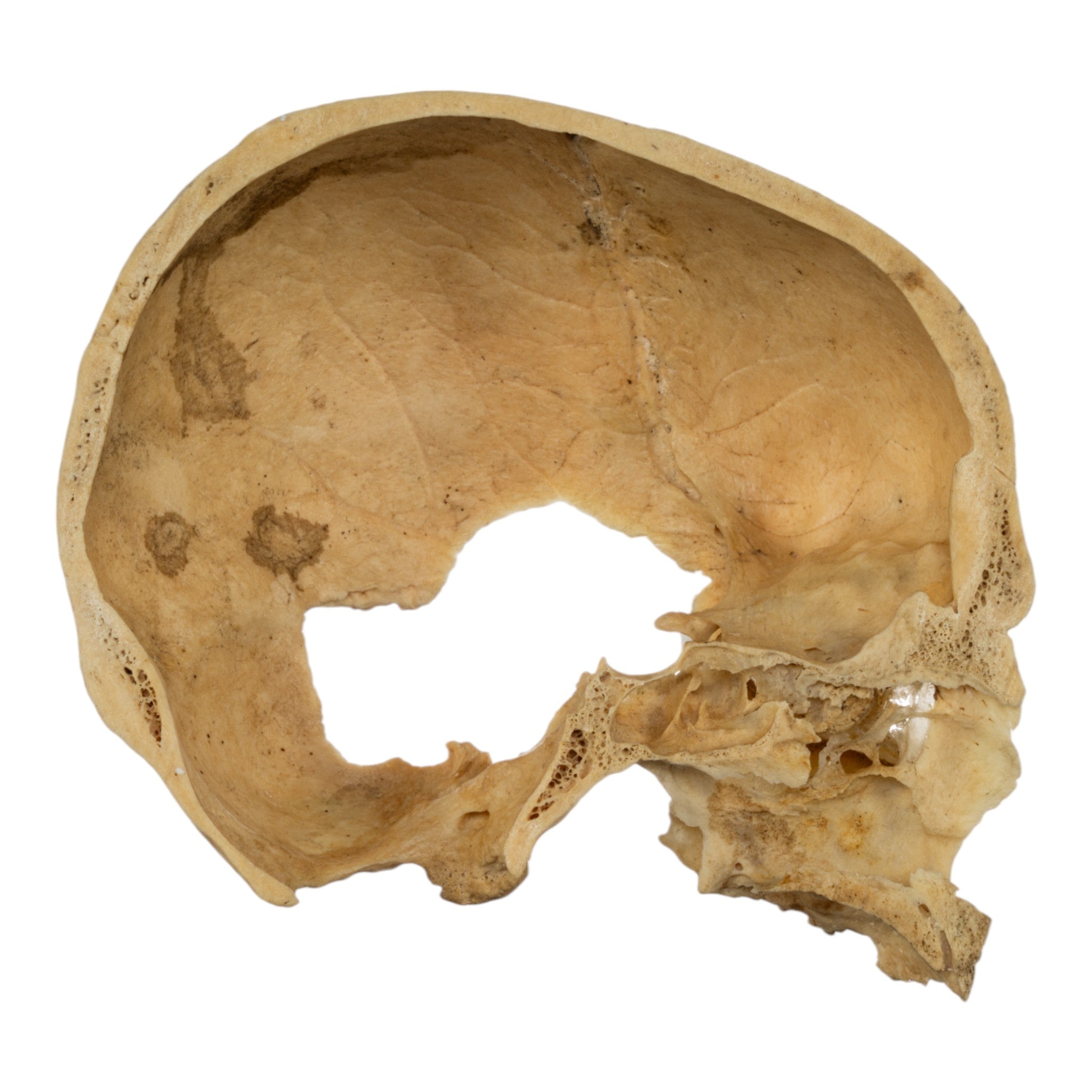 Real Human Partial Skull For Sale — Skulls Unlimited International