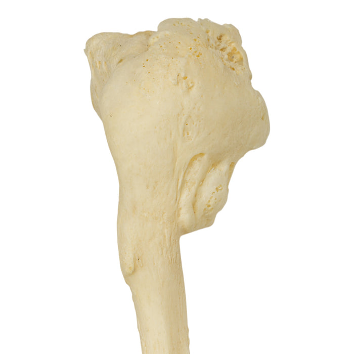 Real Human Fibula - Pathology