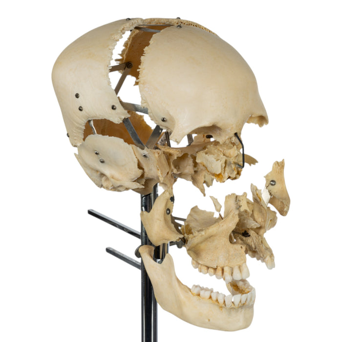 Real Human Exploded Skull on Stand