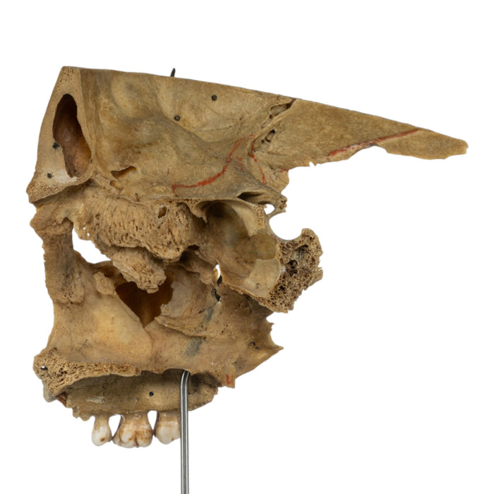 Real Human Partial Skull on Stand