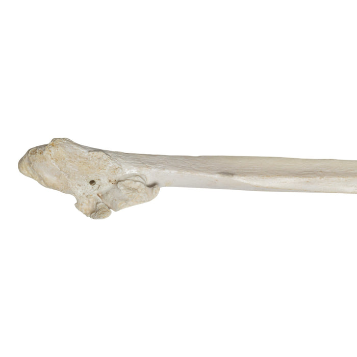 Real Human Fibula - Pathology