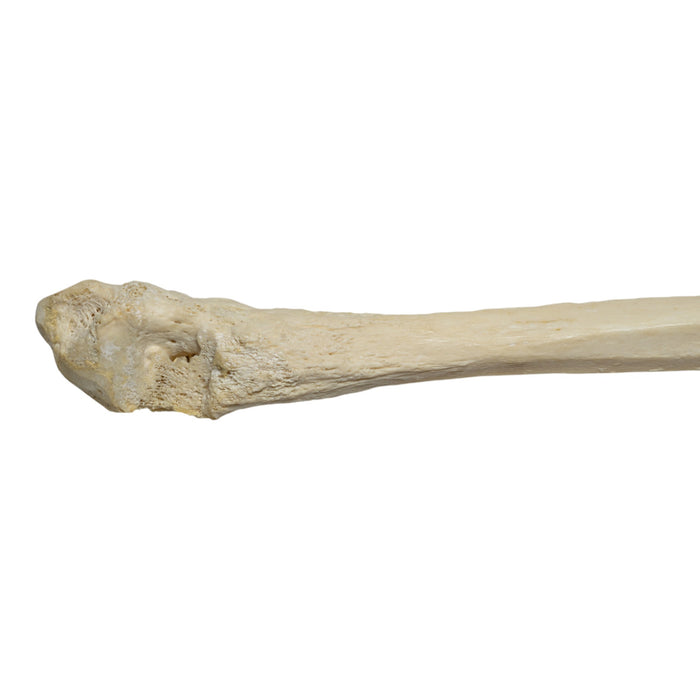 Real Human Fibula - Pathology