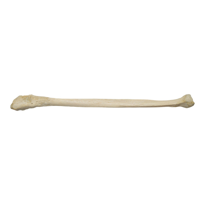 Real Human Fibula - Pathology