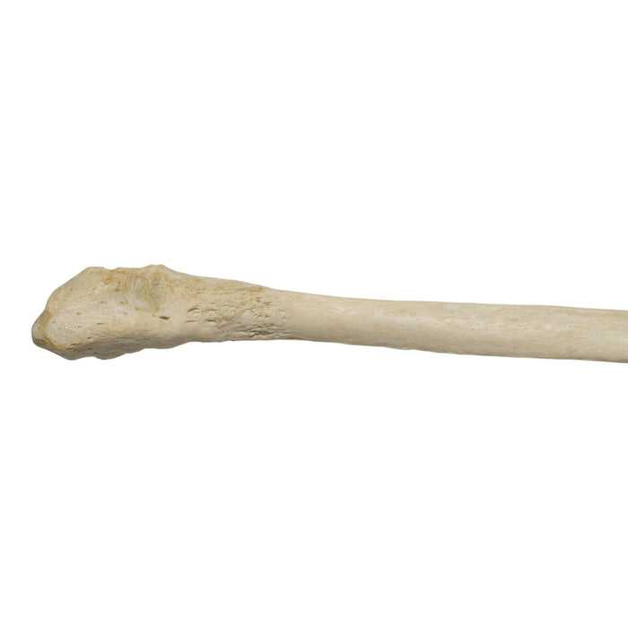 Real Human Fibula - Pathology