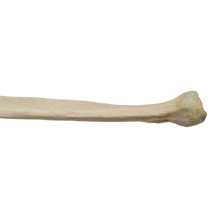Real Human Fibula - Pathology