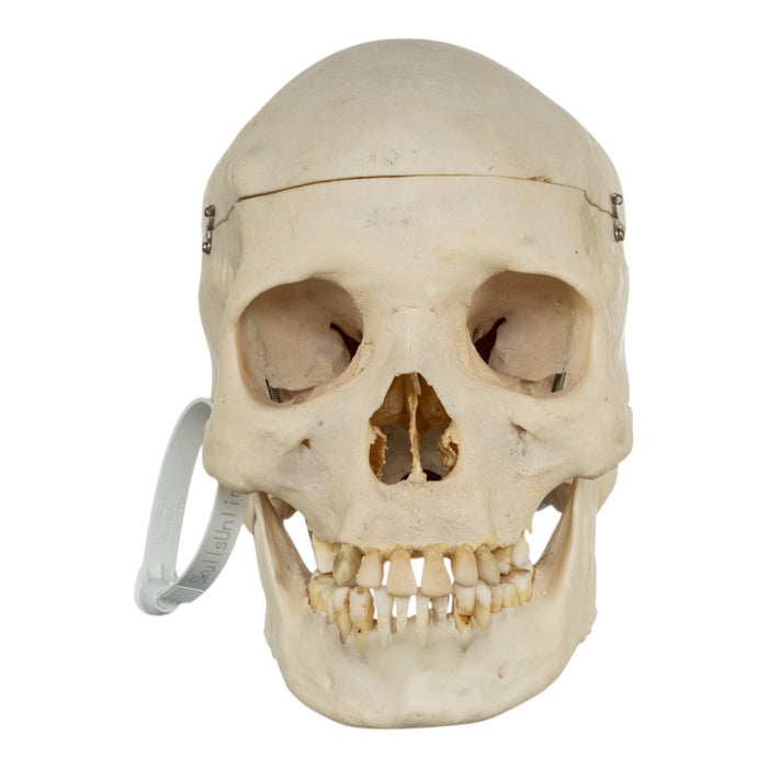 Real Human Skull - Pathology