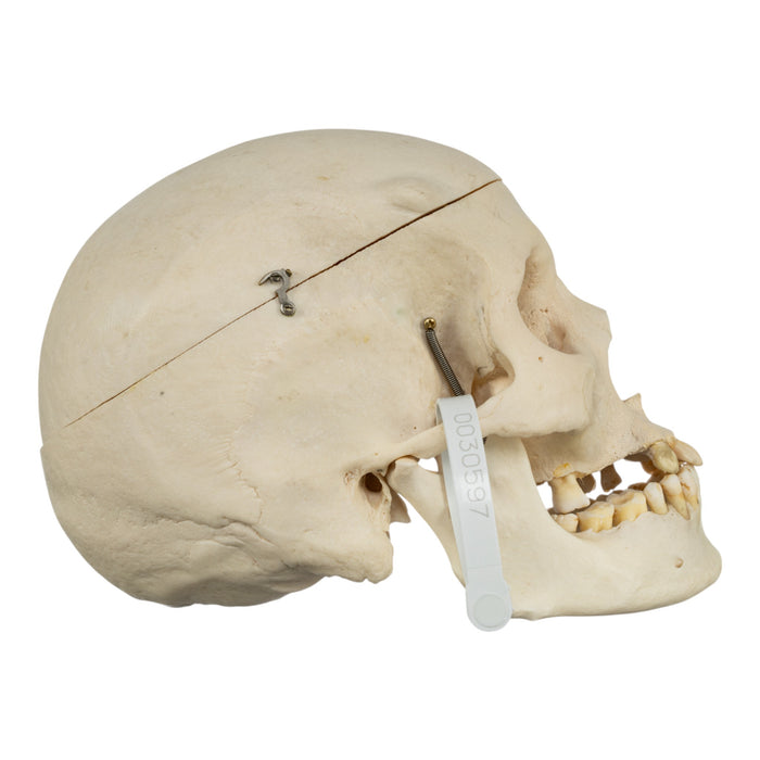 Real Human Skull - Pathology
