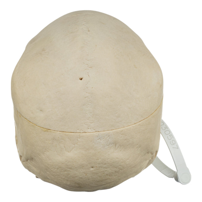 Real Human Skull - Pathology