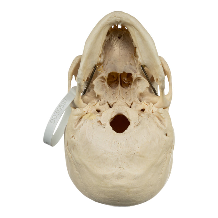 Real Human Skull - Pathology