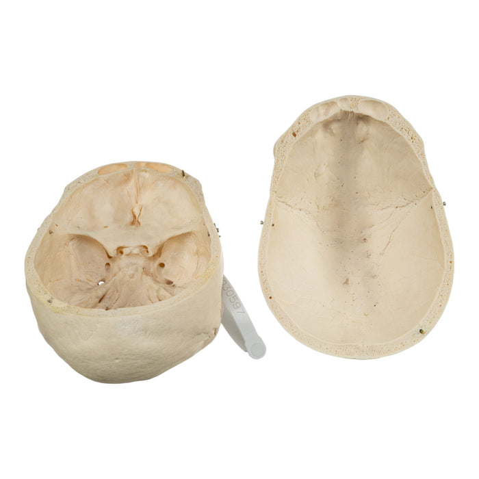Real Human Skull - Pathology